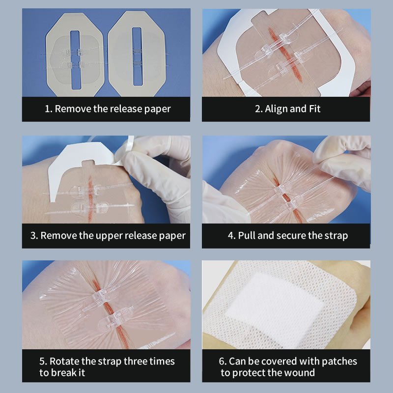 how to use the zipstitch wound closure device to treat a wound