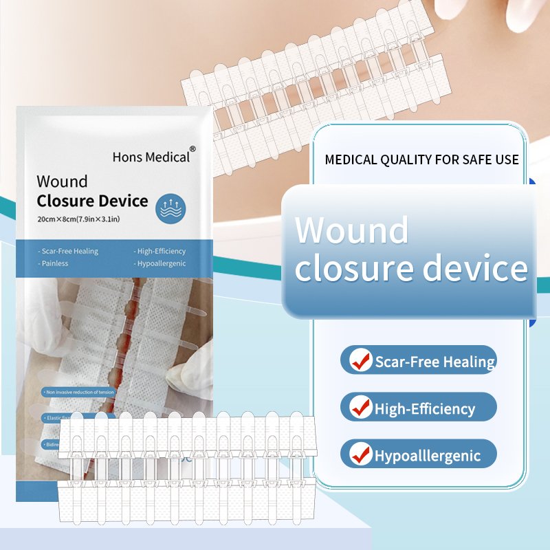 Double-Side Buckle Wound Closure Device, new generation of wound closure for C-section (Cesarean) wound closure