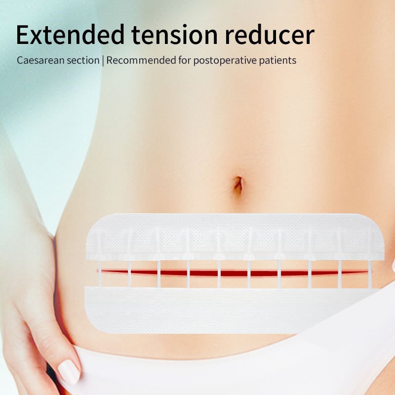 Surgical zip non-invasive strip, zipper wound closure device for pregnancy, painless solution