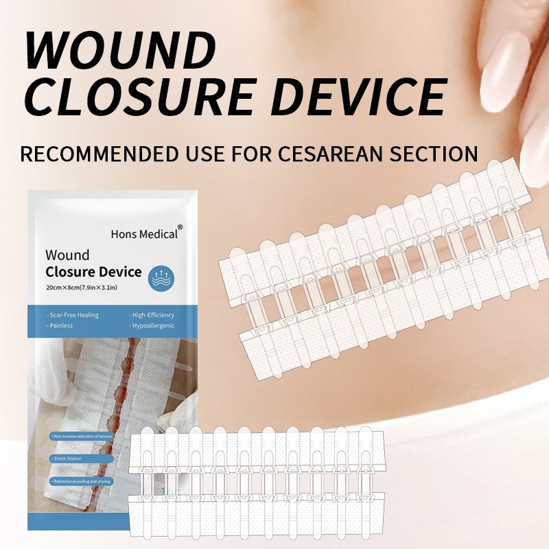 Zip Surgical Skin Closure Devices Double-Side Buckle Wound Closure Device, ny generation af sårlukning til lukning af kejsersnitssår