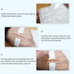 how to use wound closure device from HONS Medical