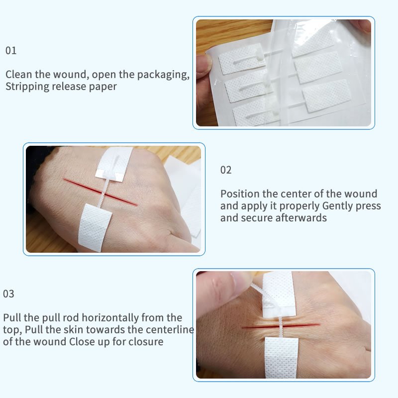 how to use zip wound closure device from HONS Medical