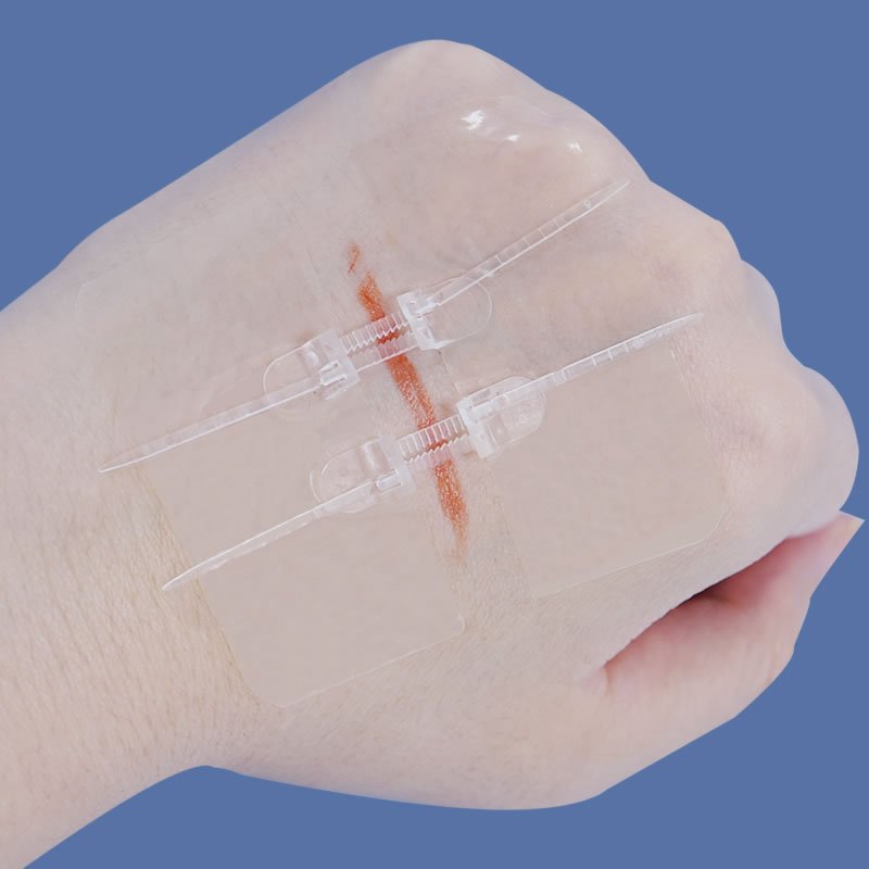 how to use zip stitch wound closure device